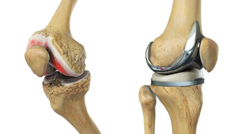Knee Replacement Surgery