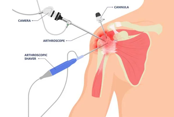 Shoulder Arthroscopic Surgery